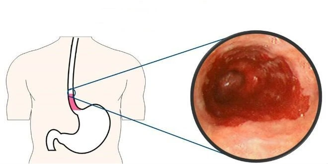 Esophageal Cancer ? Causes,Symptoms,Treatment,Preventive Measures